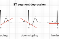 The ST Segment • LITFL • ECG Library Basics