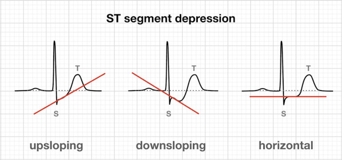 The ST Segment • LITFL • ECG Library Basics